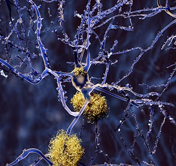 Preventing Alzheimer’s Disease