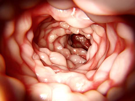 How to Prevent Crohn’s and Colitis