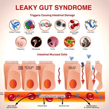 Leaky Gut Syndrome