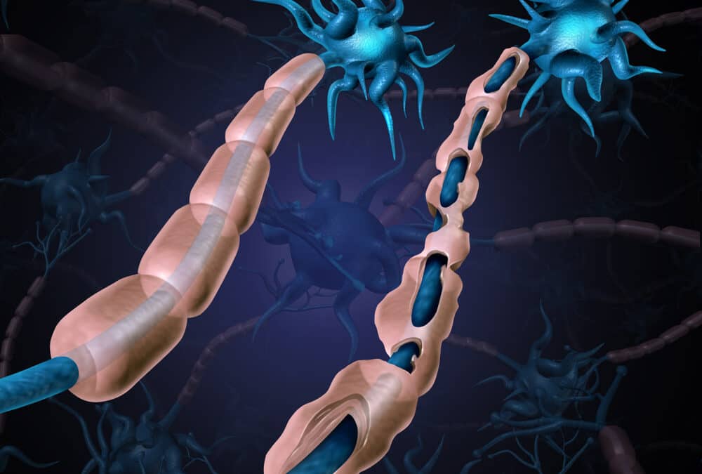 How to Prevent Multiple Sclerosis