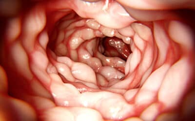 How to Prevent Crohn’s and Colitis