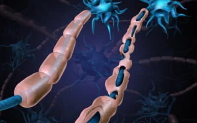 How to Prevent Multiple Sclerosis